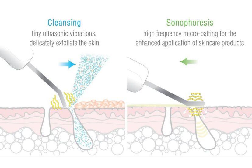 Rio Ultrasonic Facial